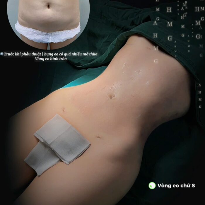 hút mỡ bụng eo